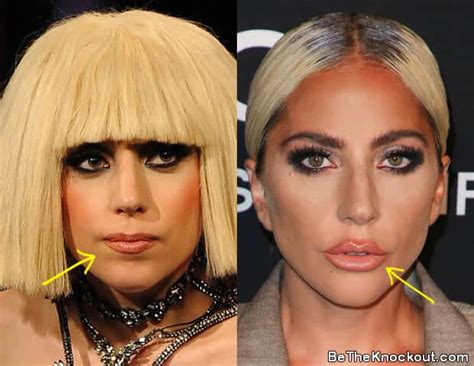 lady gaga surgery|A Surgeon Breaks Down Lady Gaga’s Potential Cosmetic